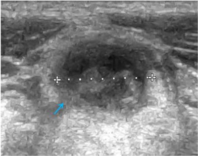 Imaging in children with ataxia-telangiectasia—The radiologist’s approach